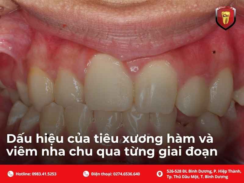 Nguyên nhân chính dẫn đến viêm nha chu và tiêu xương