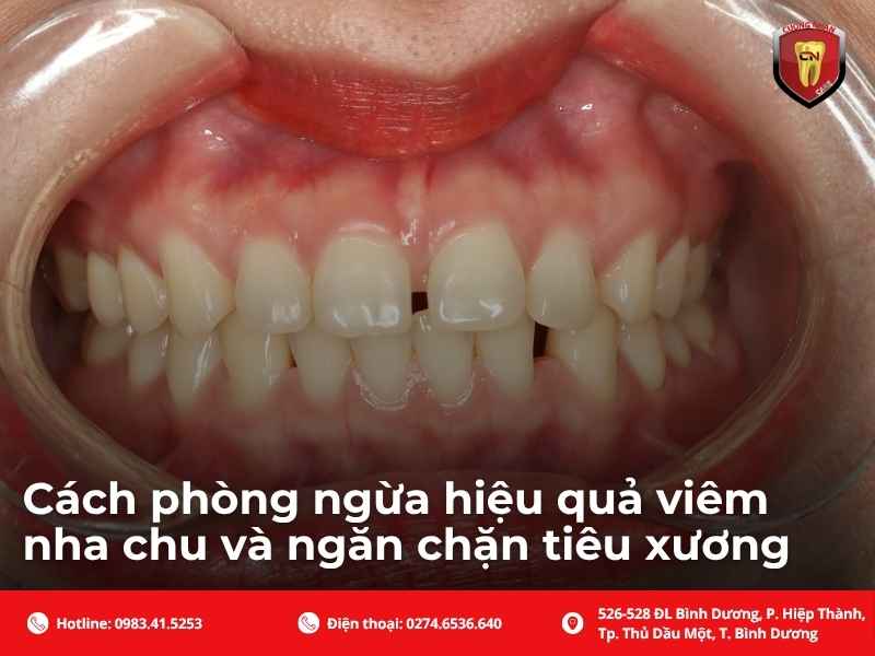 Viêm nha chu tiêu xương có chữa được không và điều trị bằng cách nào?