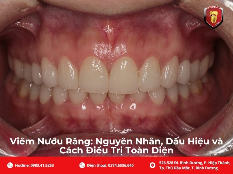 Viêm nướu răng là gì? Nguyên nhân, dấu hiệu và cách điều trị