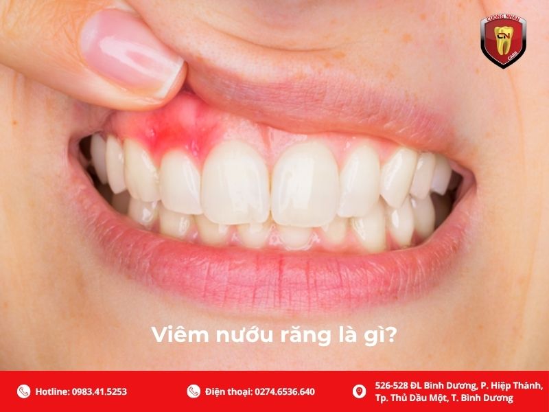 Viêm nướu răng là gì?