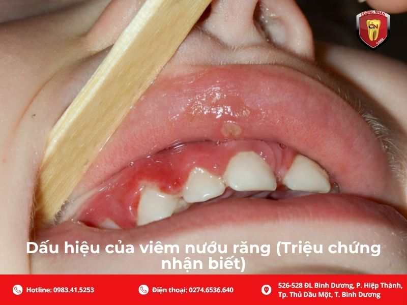 Dấu hiệu của viêm nướu răng (Triệu chứng nhận biết)