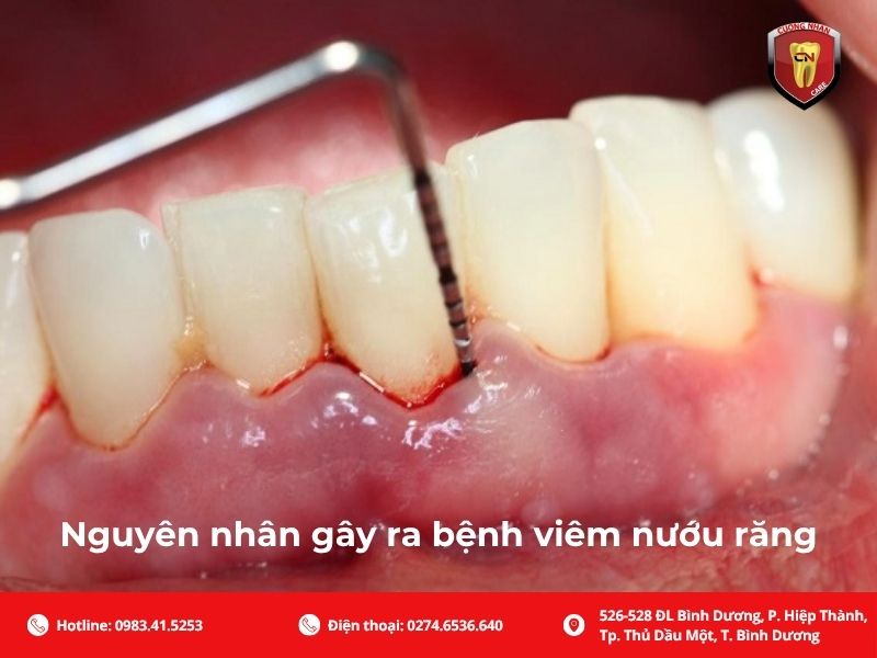 Nguyên nhân gây ra bệnh viêm nướu răng