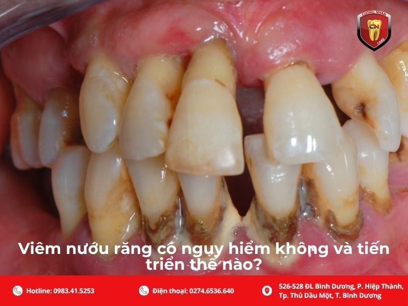 Viêm nướu răng có nguy hiểm không và tiến triển thế nào?