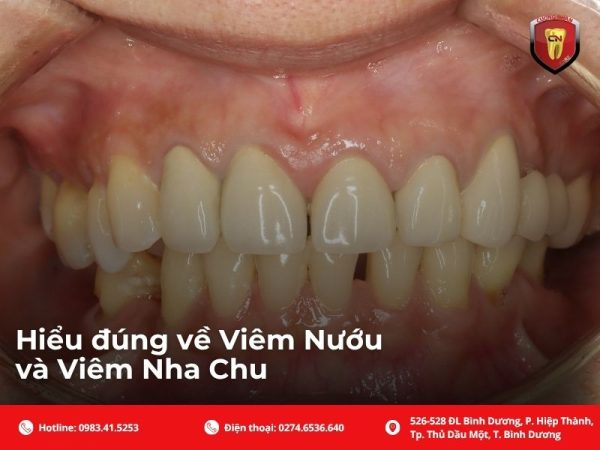 Hiểu đúng về viêm nướu và viêm nha chu