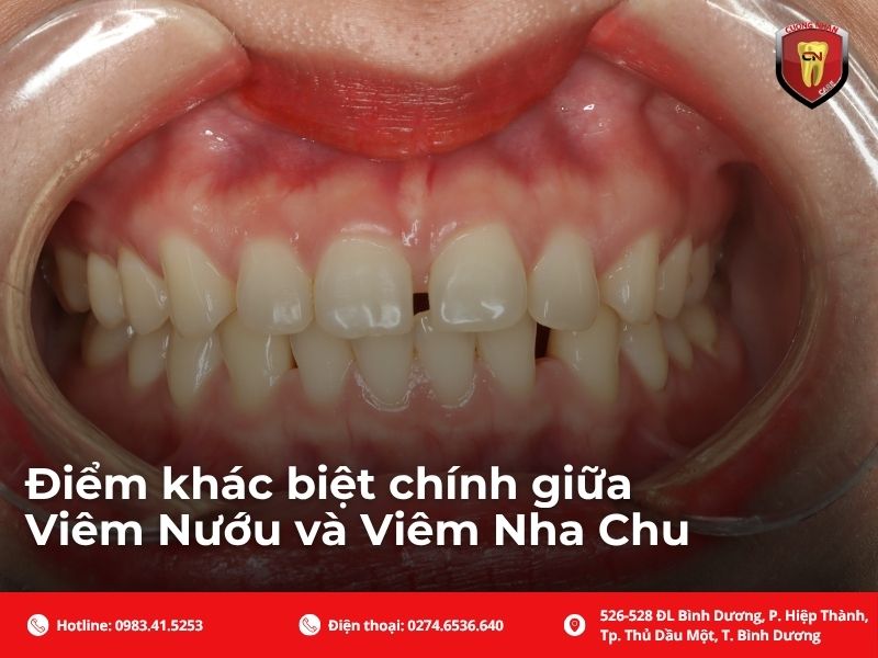 Điểm khác biệt chính giữa viêm nướu và viêm nha chu