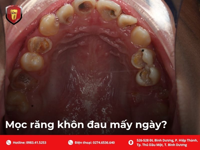 Mọc răng khôn đau mấy ngày?