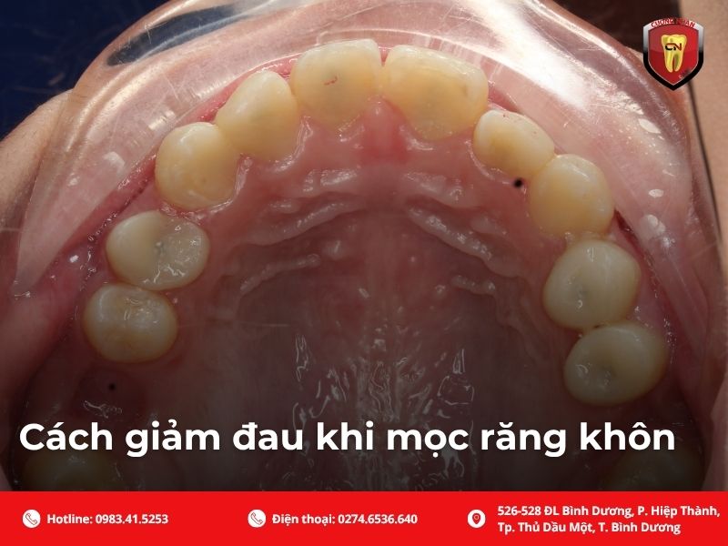Dấu hiệu mọc răng khôn là gì?