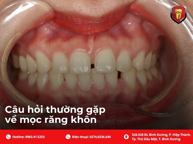 Dấu hiệu cần gặp bác sĩ và khi nào cần nhổ răng khôn