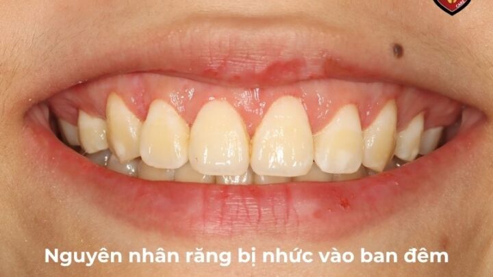 Răng Bị Nhức Vào Ban Đêm: Nguyên Nhân Và Cách Giảm Đau