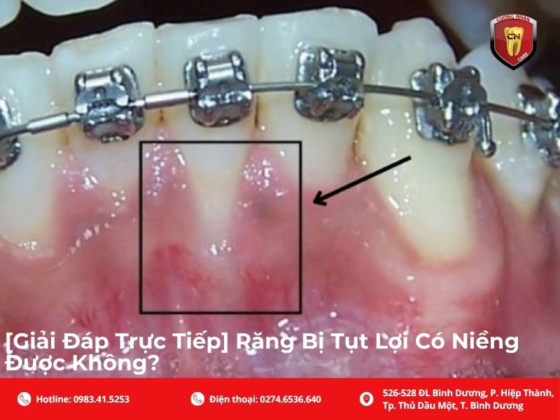 Răng bị tụt lợi có niềng được không