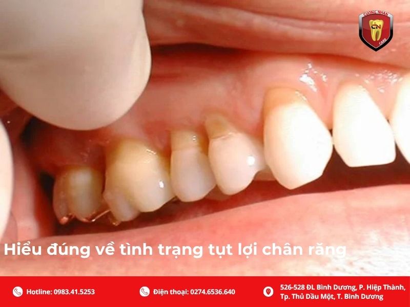 Hiểu đúng về tình trạng tụt lợi chân răng