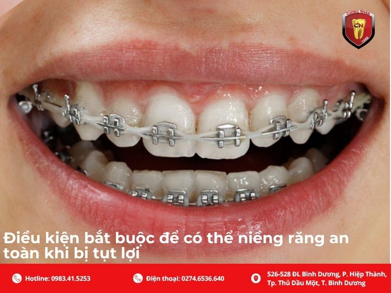 Điều kiện bắt buộc để có thể niềng răng an toàn khi bị tụt lợi