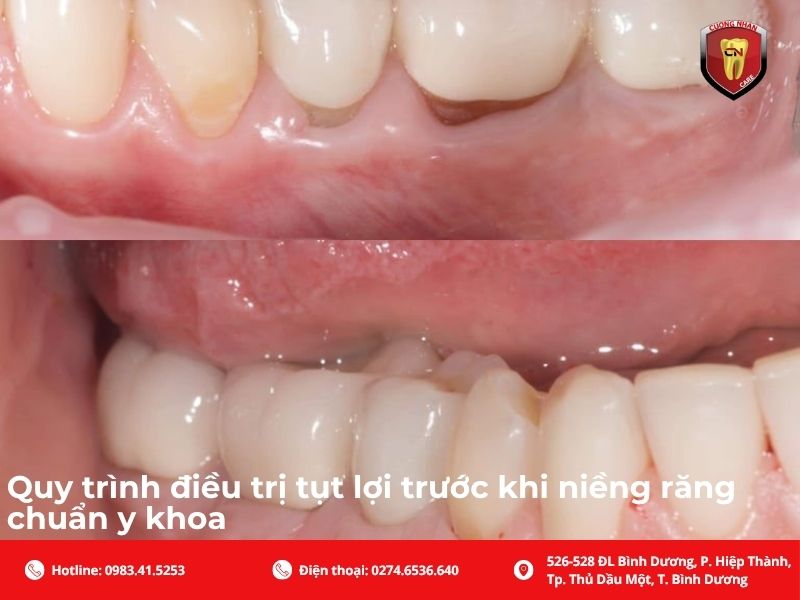 Quy trình điều trị tụt lợi trước khi niềng răng chuẩn y khoa
