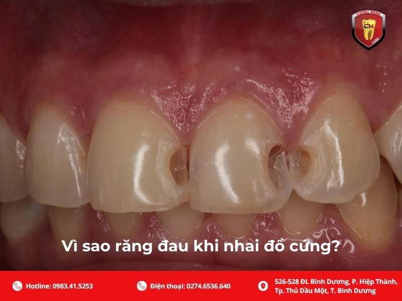 Vì sao răng đau khi nhai đồ cứng?