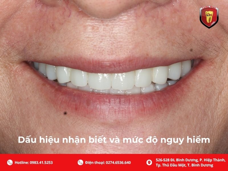 Dấu hiệu nhận biết và mức độ nguy hiểm của đau răng khi nhai