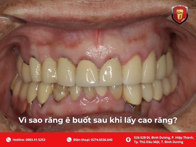 Vì sao răng ê buốt sau khi lấy cao răng?