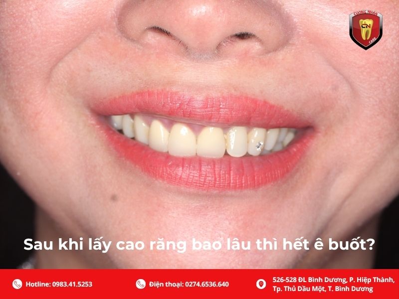 Sau khi lấy cao răng bao lâu thì hết ê buốt?