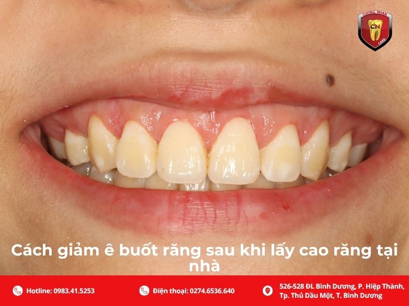 Cách giảm ê buốt răng sau khi lấy cao răng tại nhà