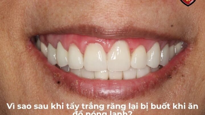 Nguyên Nhân Răng Ê Buốt Sau Khi Tẩy Trắng Và Cách Giảm Ê Buốt Ngay