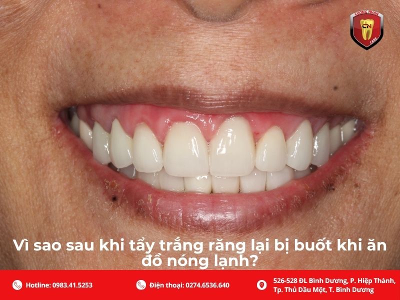 Vì sao sau khi tẩy trắng răng lại bị buốt khi ăn đồ nóng lạnh?
