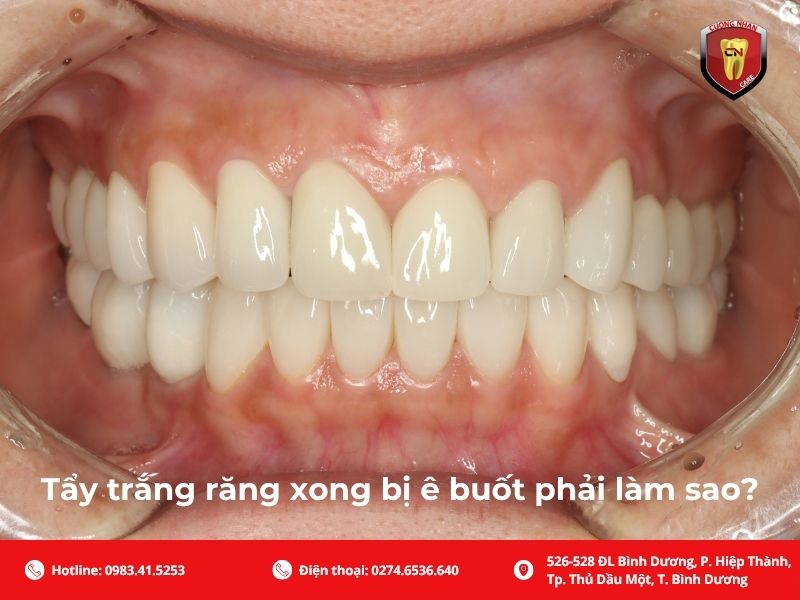 Tẩy trắng răng xong bị ê buốt phải làm sao?