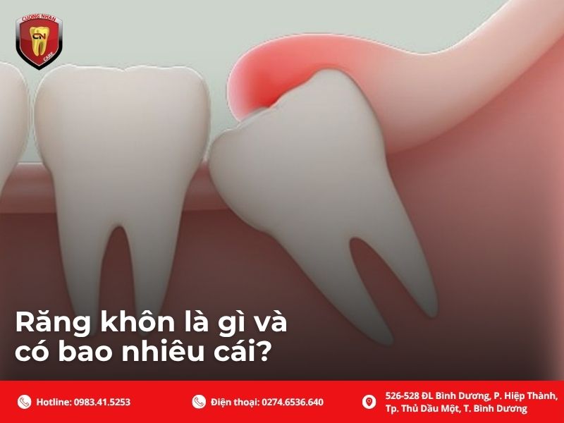 Răng khôn là gì và có bao nhiêu cái?