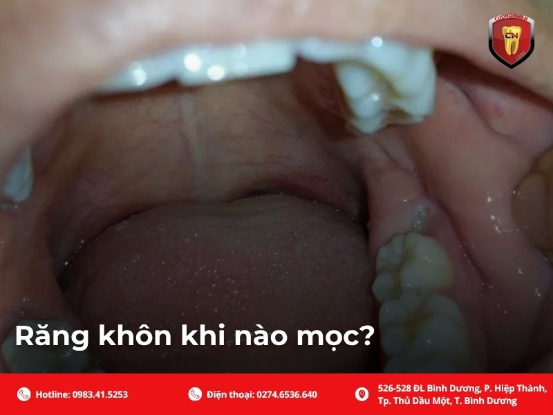 Răng khôn khi nào mọc?