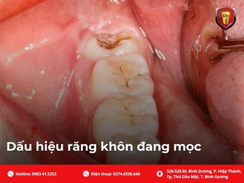 Dấu hiệu răng khôn đang mọc