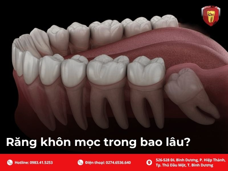 Răng khôn mọc trong bao lâu?