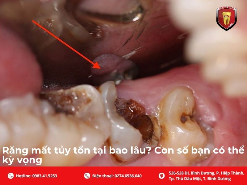 Răng mất tủy có thể thực sự tồn tại được bao lâu?