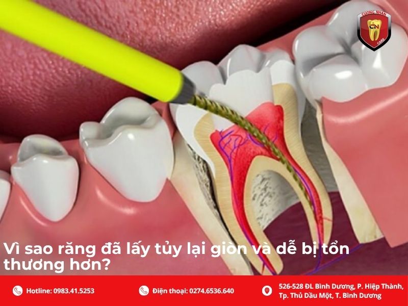 Vì sao răng đã lấy tủy lại giòn và dễ bị tổn thương hơn?