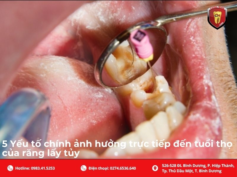 5 Yếu tố chính ảnh hưởng trực tiếp đến tuổi thọ của răng lấy tủy