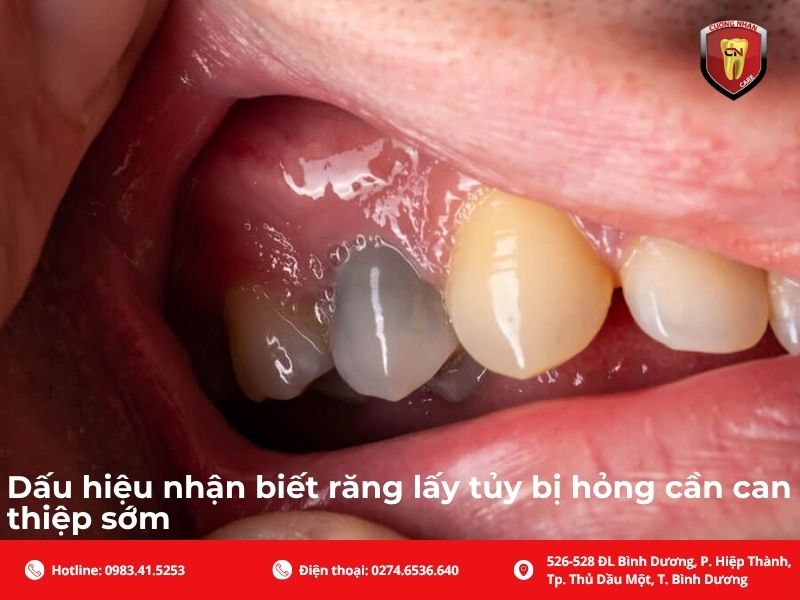 Dấu hiệu nhận biết răng lấy tủy bị hỏng cần can thiệp sớm