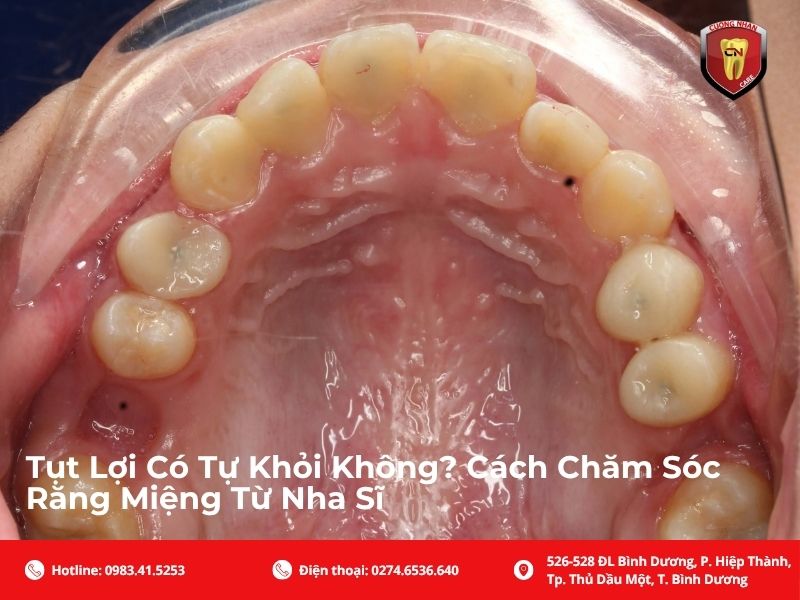 Vậy tụt lợi có tự khỏi không?