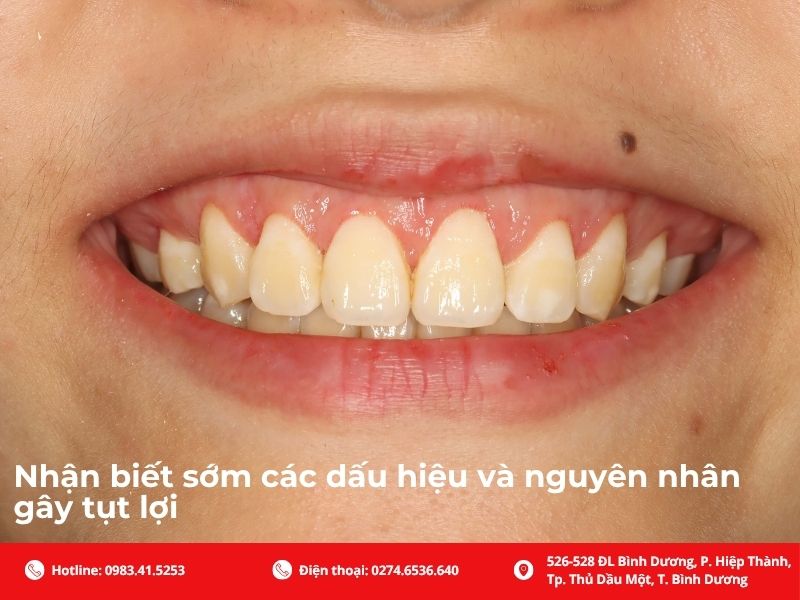 Nhận biết sớm các dấu hiệu và nguyên nhân gây tụt lợi