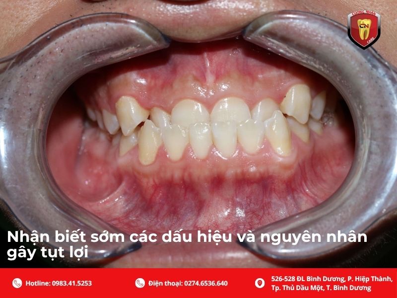 Những nguyên nhân phổ biến dẫn đến tụt lợi chân răng