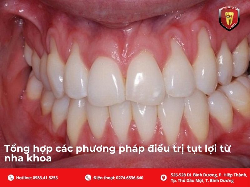 Các phương pháp điều trị tụt lợi từ nha khoa