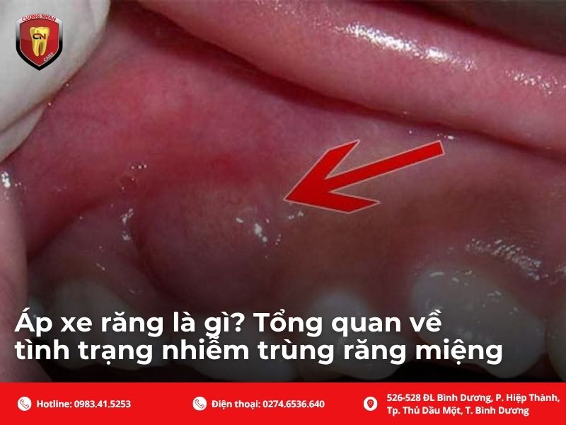 Áp xe răng là gì? Tổng quan về tình trạng nhiễm trùng răng miệng