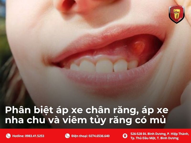 Phân biệt áp xe chân răng, áp xe nha chu và viêm tủy răng có mủ