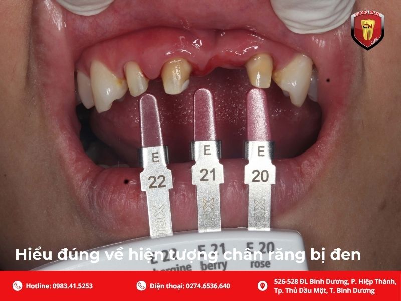 Chân răng bị đen có nguy hiểm không?