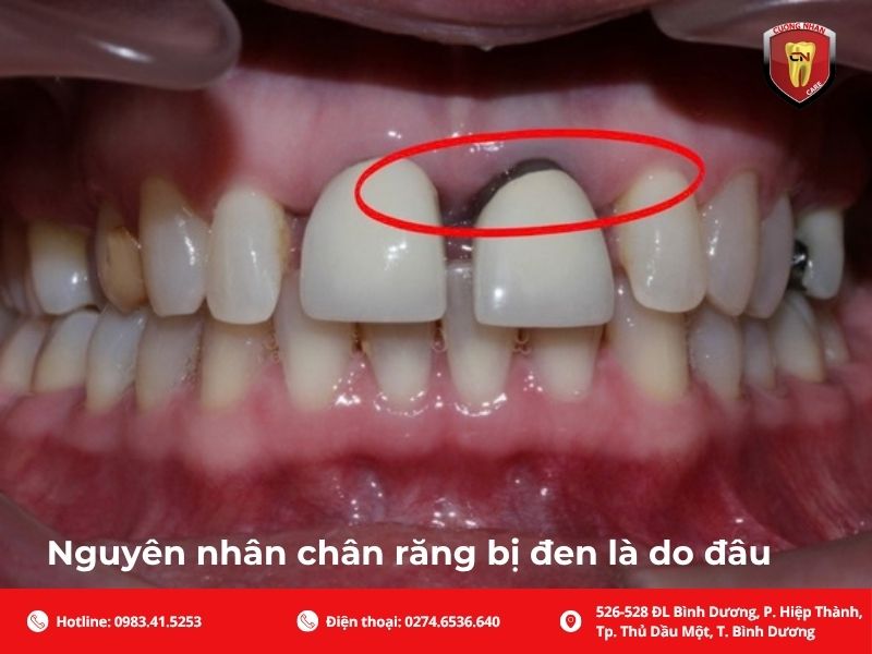 Nguyên nhân chân răng bị đen là do đâu