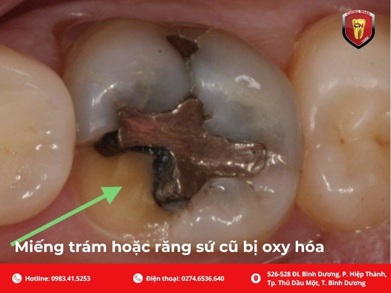 Miếng trám hoặc răng sứ cũ bị oxy hóa