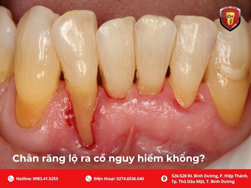 Chân răng lộ ra có nguy hiểm không?
