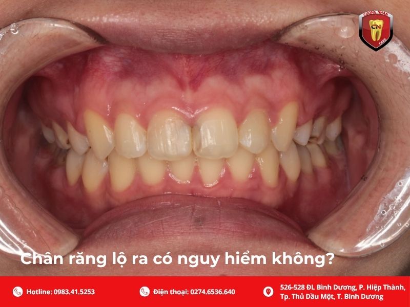 Dấu hiệu nhận biết lộ chân răng là gì?