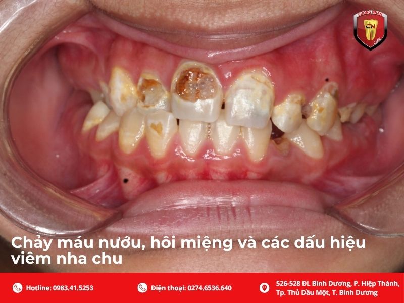 Chảy máu nướu, hôi miệng và các dấu hiệu viêm nha chu