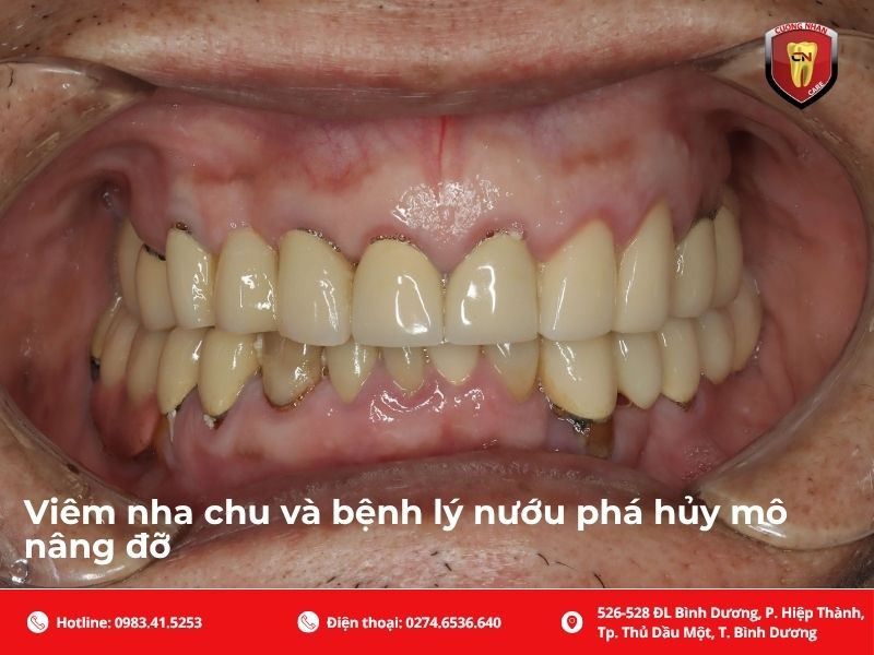 Viêm nha chu và bệnh lý nướu phá hủy mô nâng đỡ