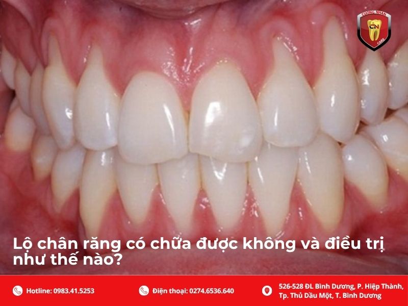 Lộ chân răng có chữa được không và điều trị như thế nào?