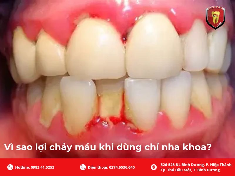 Vì sao lợi chảy máu khi dùng chỉ nha khoa?
