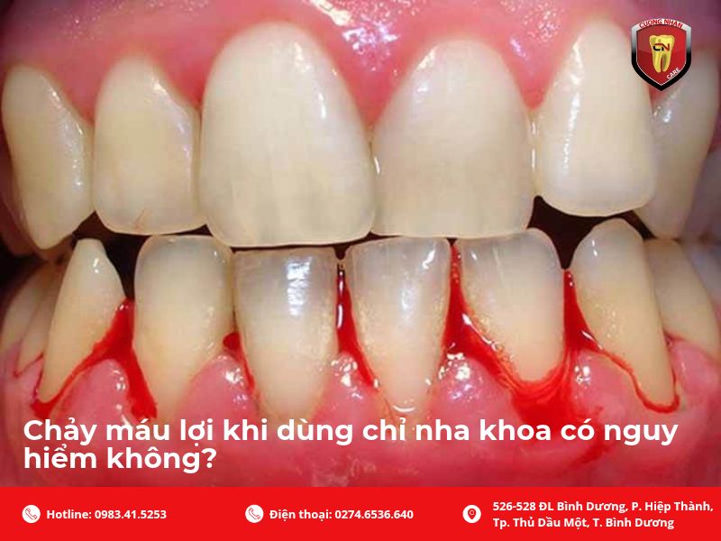 Phân biệt chảy máu thoáng qua khi mới dùng chỉ nha khoa