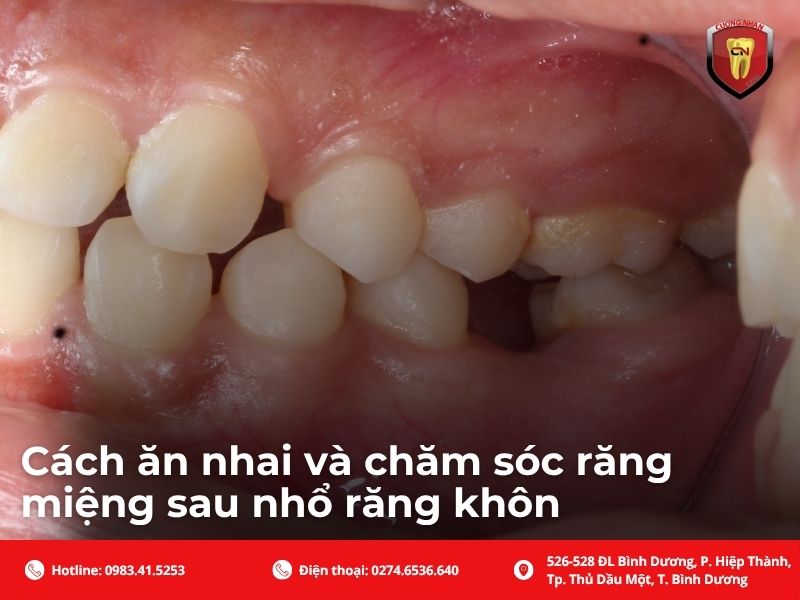 Cách ăn nhai và chăm sóc răng miệng sau nhổ răng khôn